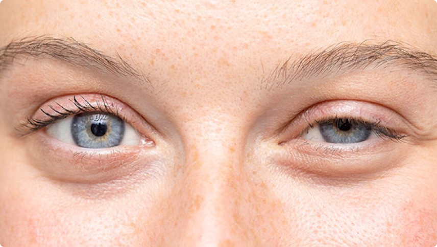 Cirurgia e reconstrução palpebral, Dra. Giovanna Piccinini